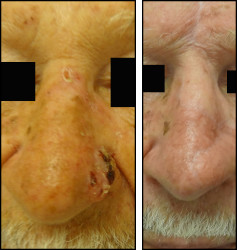facelift